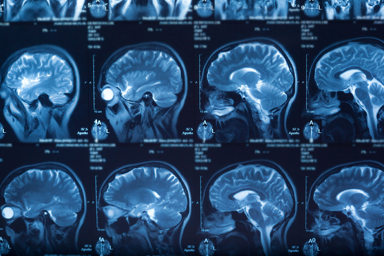 Røntgenbilde av menneskehjerne